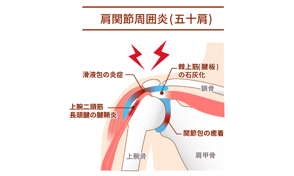 五十肩の特徴