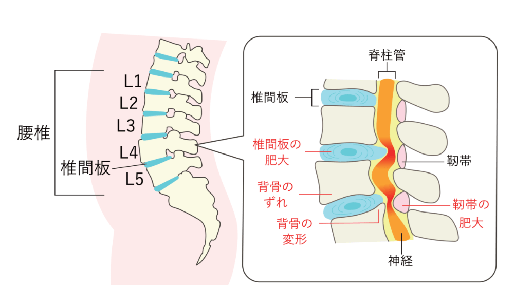 脊柱管狭窄症の拡大図