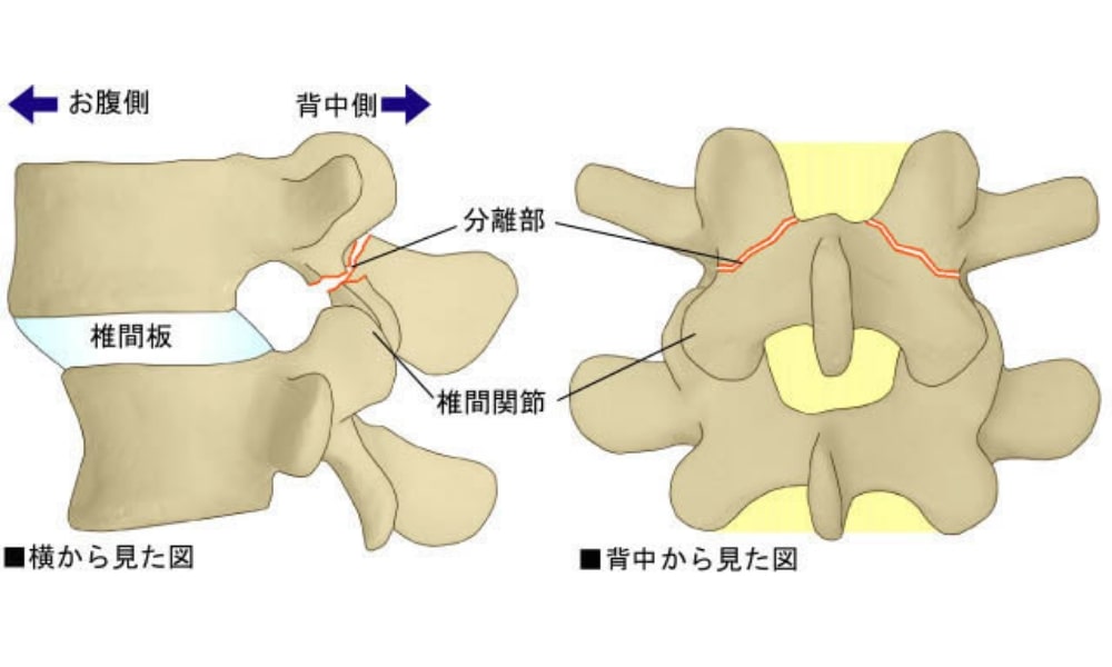 腰椎分離証のイラスト
