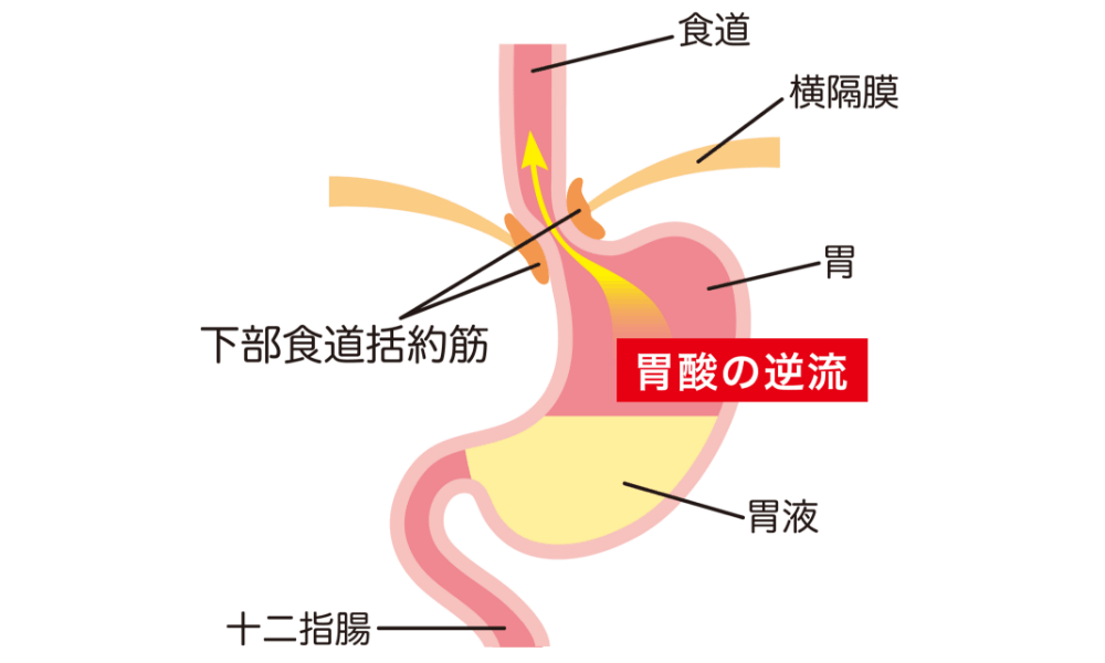 逆流性食道炎のイラスト